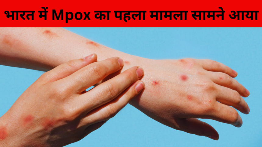 Mpox 1st case in india