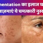 pigmentation