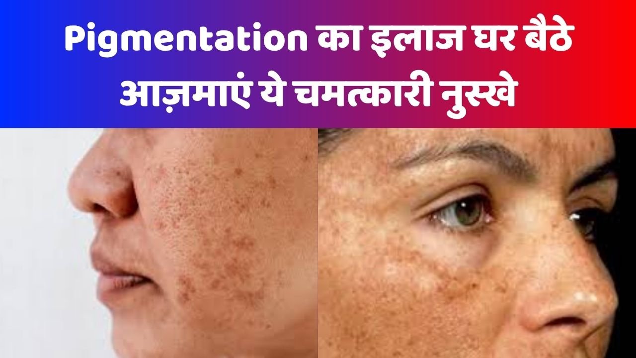 pigmentation